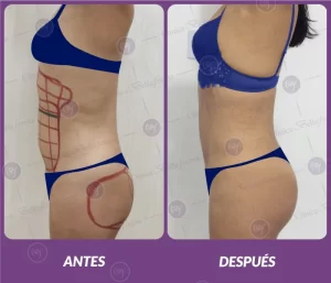 Lipotransferencia 2